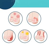 Gelová ochrana prstů před odřením a puchýři