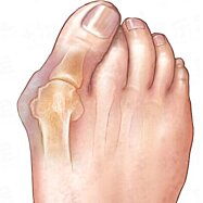 Chránič na malíček s gelovým klínem, 7 x 1 cm, 1 ks